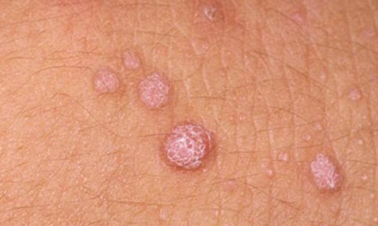 HPV larruazaleko papilomak agertzea dakar