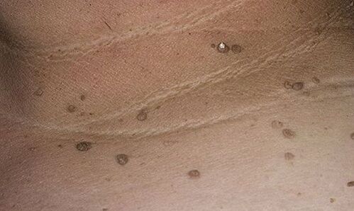 giza papilomabirusaren agerpenak