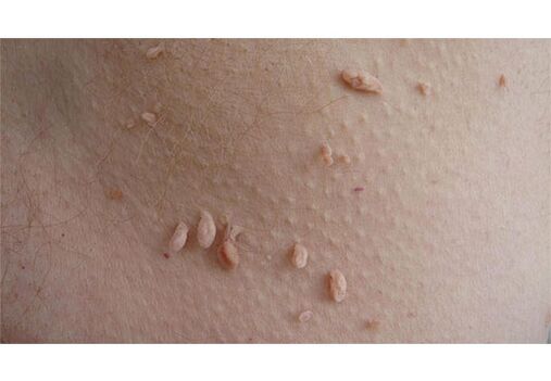 VPH infekzioaren seinale da gorputzean papilomak agertzea