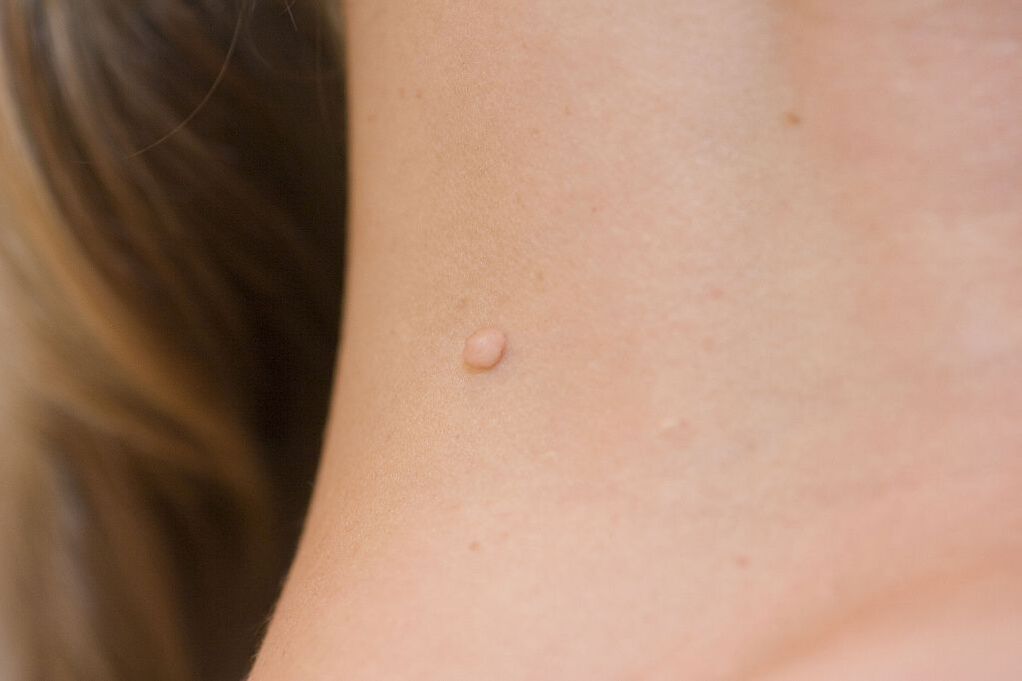 HPV sintomak