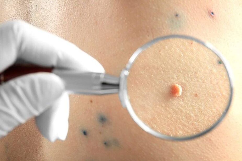 HPV tratamendua