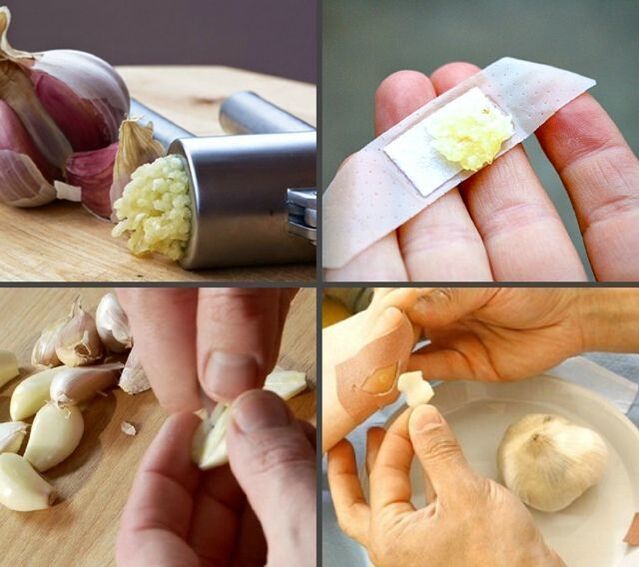 hanketako papilomak tratatzea