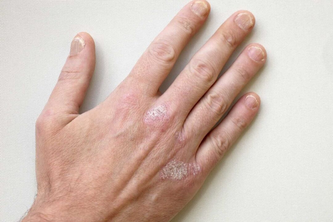 psoriasia gizon baten eskuetan Keramin kremarekin tratamendua
